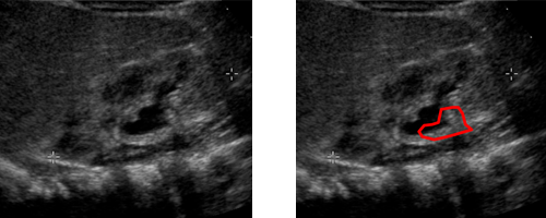 Rechte Niere von der Seite eingeschallt (Mädchen 2 Wochen alt Nierenbecken als Herzform erkennbar